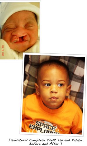 FCPA donation donate florida cleft palate craniofacial association